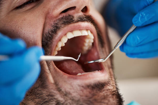 Best Emergency Wisdom Tooth Extraction in New Chicago, IN